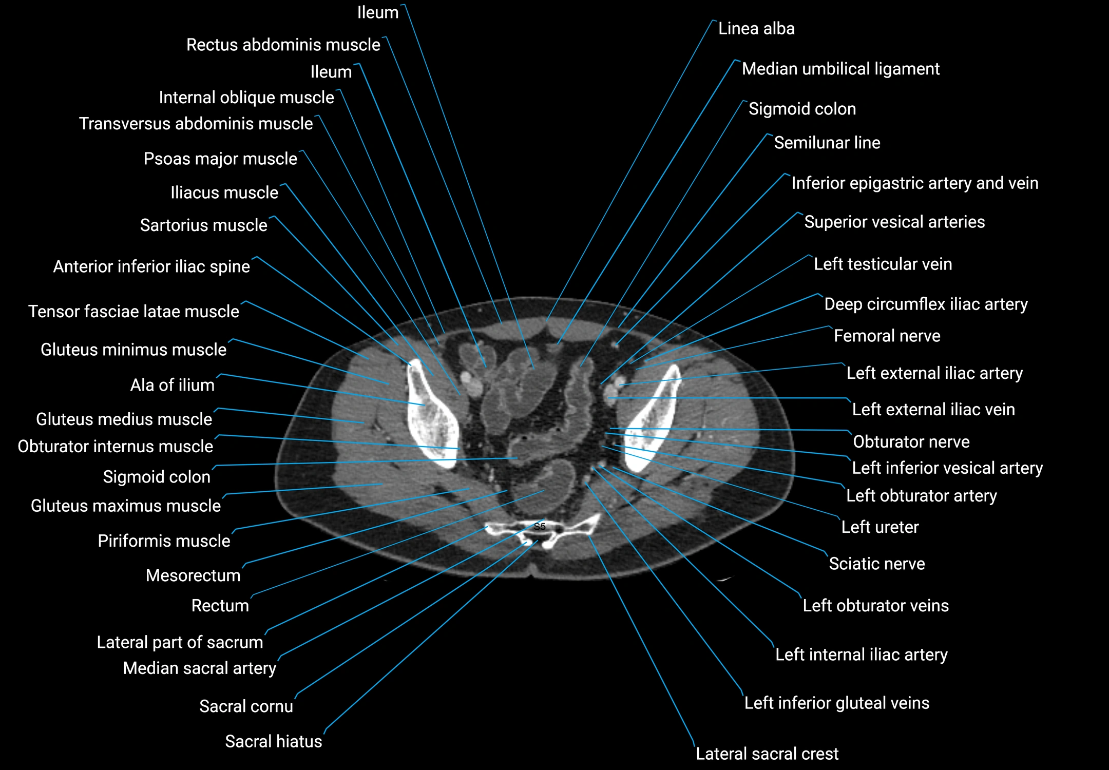 CT male pelvis axial cross sectional anatomy labelled radiology image -00170.webp